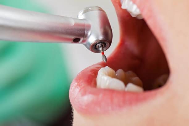 Best Emergency Wisdom Teeth Removal in Patrick Springs, VA